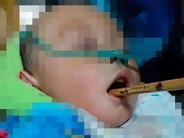 Mẹ bưng bát chạy theo đút cơm, bé trai 2 tuổi gặp nạn với chiếc đũa