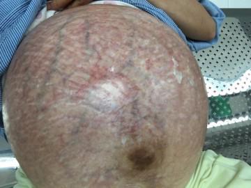 Rớt nước mắt nhìn bụng mẹ bầu rạn nứt, căng tròn thấy rõ từng mạch máu