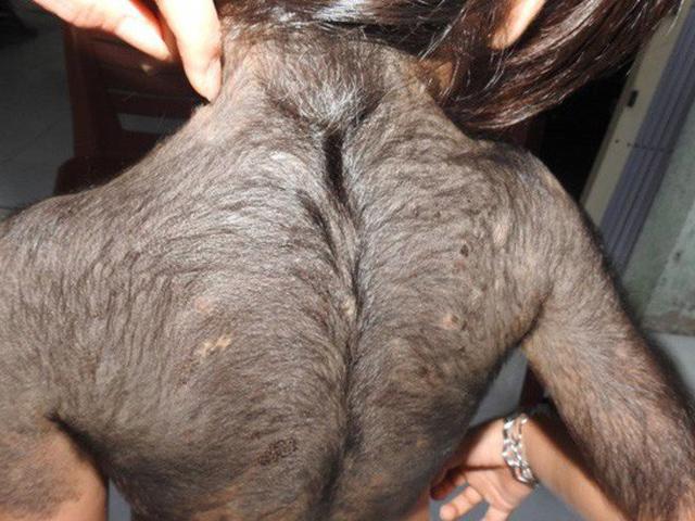 Uống thuốc 6 tháng tăng 10 cân, bé gái mọc lông đầy mình