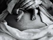 Bà bầu - Mang thai sau sinh mổ, mẹ 2 con bất ngờ gặp phải biến chứng cực kì nguy hiểm