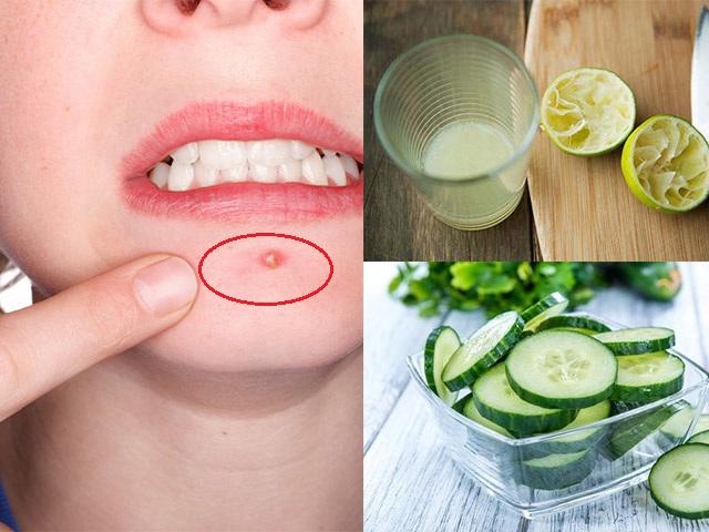 Với 5 ngàn đồng có ngay cách trị mụn bọc ở cằm hiệu quả chỉ sau 1 tuần