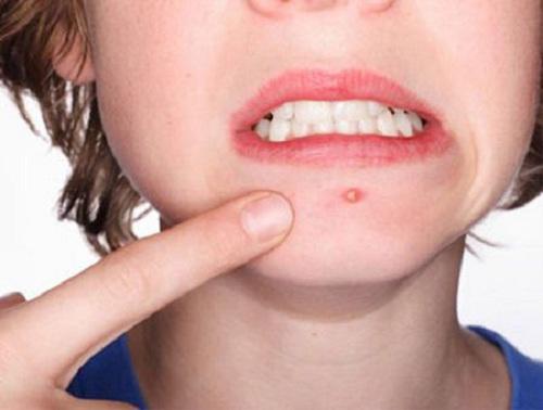 Với 5 ngàn đồng có ngay cách trị mụn bọc ở cằm hiệu quả chỉ sau 1 tuần - 1