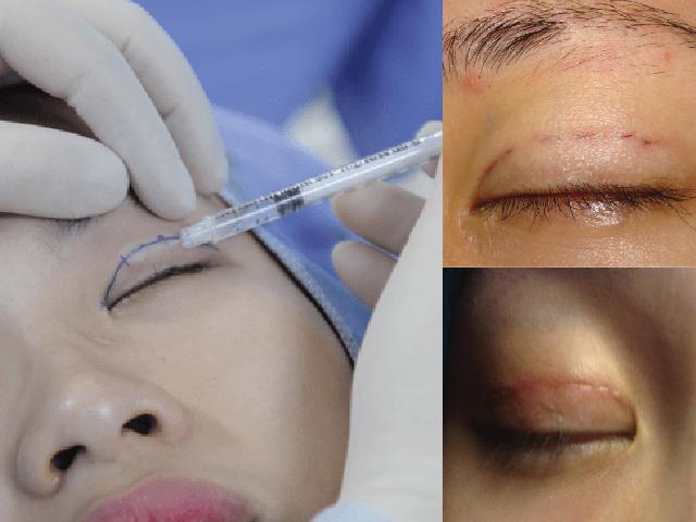 Là tiểu phẫu, nhưng cắt mí vẫn có thể để lại sẹo nếu chị em không biết những điều sau