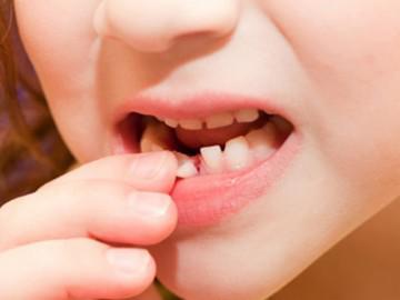 Những lưu ý khi trẻ thay răng sữa để bé sở hữu hàm răng đều và đẹp khi lớn