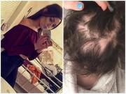 Sức khỏe - Bệnh lạ khiến cô gái 19 tuổi lần lượt rụng cả tóc lẫn lông mày