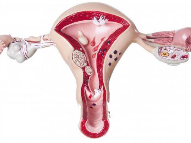 Phụ nữ cần nắm chắc kiến thức về buồng trứng đa nang nếu không muốn bị vô sinh