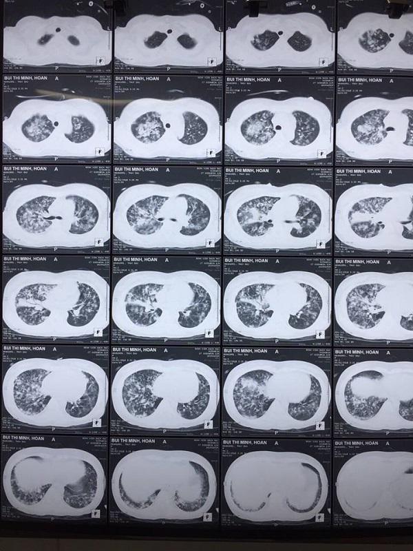 Vừa tháo khớp 4 đốt ngón tay, cô gái trẻ nguy kịch do biến chứng của bệnh thủy đậu - 1