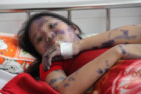 Vừa tháo khớp 4 đốt ngón tay, cô gái trẻ nguy kịch do biến chứng của bệnh thủy đậu - 3