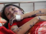 Tin tức - Vừa tháo khớp 4 đốt ngón tay, cô gái trẻ nguy kịch do biến chứng của bệnh thủy đậu