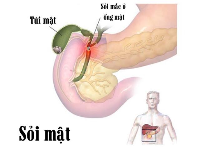 Không muốn bị sỏi mật amp;#34;đeo bámamp;#34;, cần nắm chắc những kiến thức này - 3