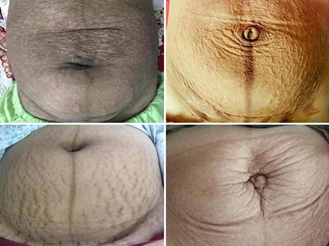 Sau sinh mẹ được gì? - Em bé như thiên thần và vùng bụng như thửa ruộng cằn cỗi