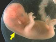 Bà bầu - Vì sao mẹ bầu nào cũng nên đi đo độ mờ da gáy của thai nhi