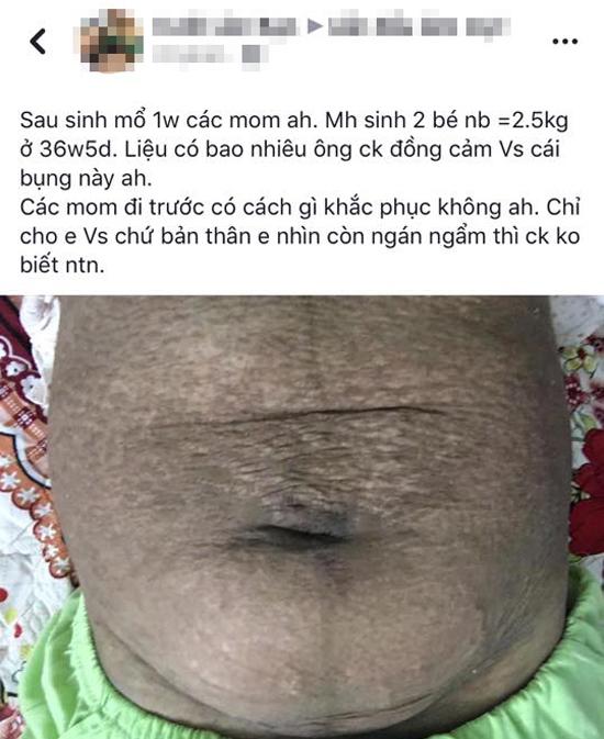 Sau sinh mẹ được gì? - Em bé như thiên thần và vùng bụng như thửa ruộng amp;#34;cằn cỗiamp;#34; - 1
