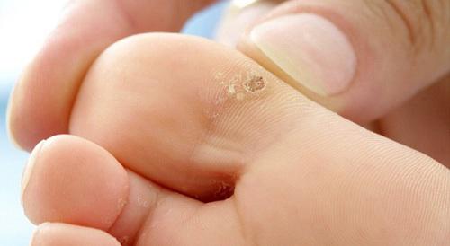 Đắp 3 amp;#34;thần dượcamp;#34; này mỗi ngày, bạn sẽ không bao giờ biết đến mụn cóc ở chân là gì! - 1