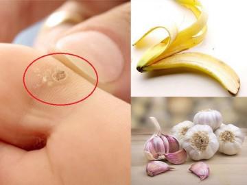 Đắp 3 thần dược này mỗi ngày, bạn sẽ không bao giờ biết đến mụn cóc ở chân là gì!