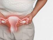 Sức khỏe - U xơ cổ tử cung – căn bệnh nữ giới trên 30 tuổi có nguy cơ mắc đến 50%