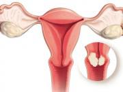 Sức khỏe - Đừng chủ quan trước triệu chứng của ung thư cổ tử cung