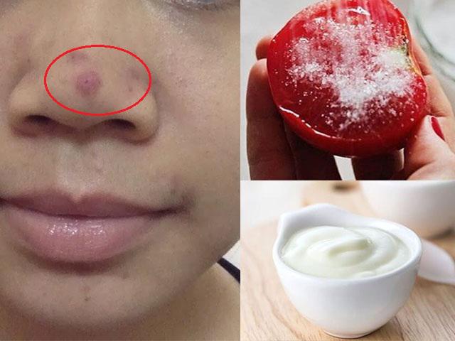 5 cách trị mụn bọc tại nhà dù mụn có to đến đâu cũng xẹp lép chỉ sau 1 đêm