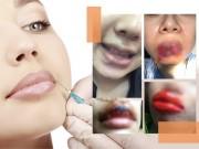 Đẹp - Chẳng may môi bị hỏng do "dao kéo", chị em phải xử trí sao cho khéo?