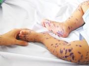 Sức khỏe - Bệnh thuỷ đậu dùng thuốc như thế nào?