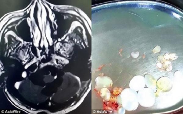 Bác sĩ sốc khi phát hiện 30 trứng sán dây trong não bệnh nhân vì ăn thịt sống - 1