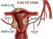 Sức khỏe - Dấu hiệu u xơ tử cung mà các chị em nhất định phải nắm rõ