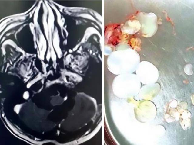 Buồn nôn đến viện khám, không ngờ phát hiện 30 trứng sán dây trong đầu