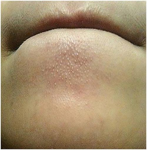 Bỏ túi 2 cách này mụn ẩn cứng đầu đến đâu cũng sạch bách đến đấy - 1