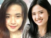 Làm đẹp - Bỏ túi 2 cách này mụn ẩn cứng đầu đến đâu cũng sạch bách đến đấy