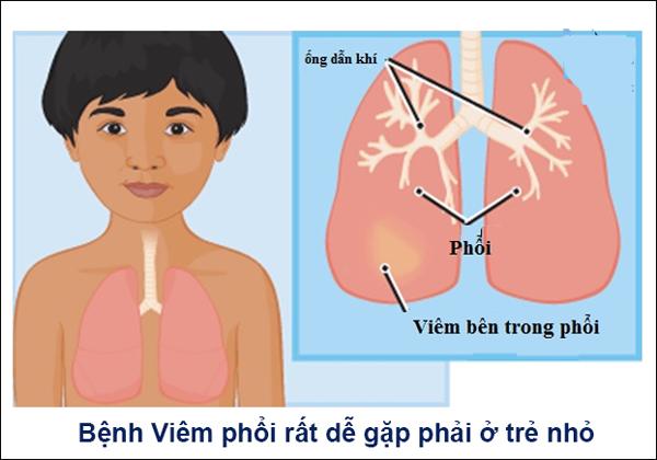 Những điều bậc cha mẹ bắt buộc phải biết về viêm phổi ở trẻ - 2