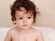 Làm mẹ - Mùa dịch bệnh thủy đậu ở trẻ em: Chi tiết cách điều trị và những kiêng kỵ