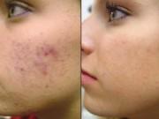 Làm đẹp - Da mụn thâm đỏ chi chít cũng giảm sưng hơn chỉ trong vài bước