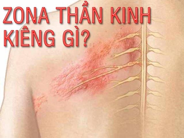 Zona thần kinh kiêng gì? - 1