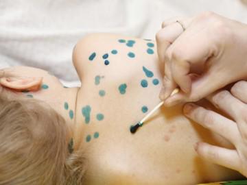 6 hiểu lầm tai hại về bệnh thủy đậu khiến bệnh càng thêm trầm trọng