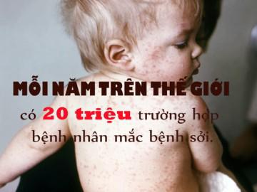 Trẻ bị sởi có thể điều trị tại nhà như thế nào để bé nhanh khỏi?