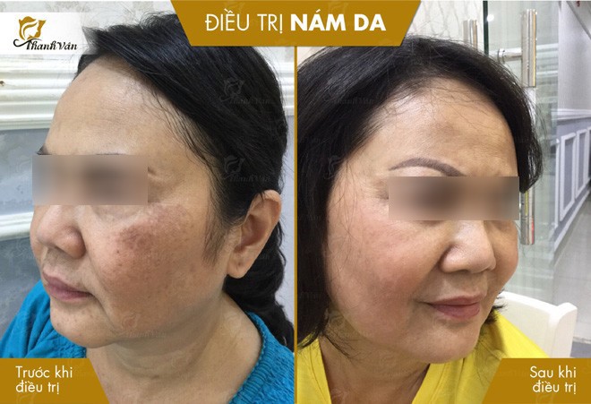Cách đơn giản để giành được suất trị nám miễn phí với công nghệ triệu đô Laser Melasma - 5