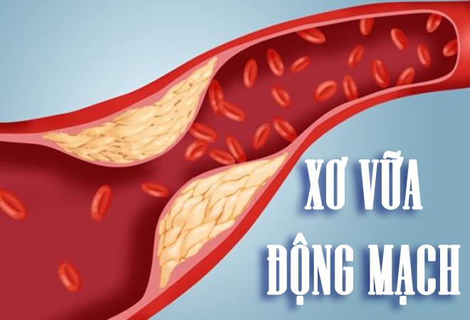 Cảnh giác trước bệnh xơ vữa động mạch có thể dẫn đến tử vong bất ngờ - 1