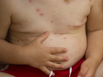 4 sai lầm "nói mãi mẹ không nhớ" khi chữa thủy đậu cho con khiến bé nặng bệnh