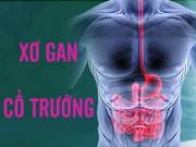 Sức khỏe - Dừng ngay việc uống rượu bia nếu không muốn bị xơ gan cổ trướng