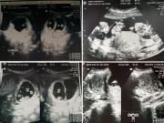 Bà bầu - Hình ảnh siêu âm thai khiến bác sĩ "tròn mắt" ngạc nhiên, mẹ bầu "tim ngừng đập" vì lo lắng