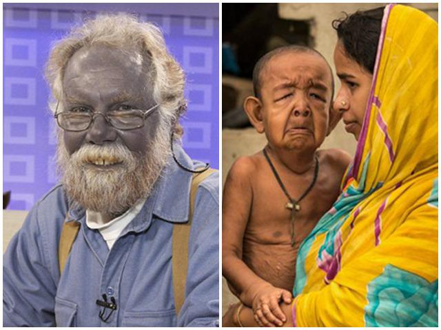 Những căn bệnh kỳ dị nhất thế giới mà toàn bộ giới y học cũng phải bó tay