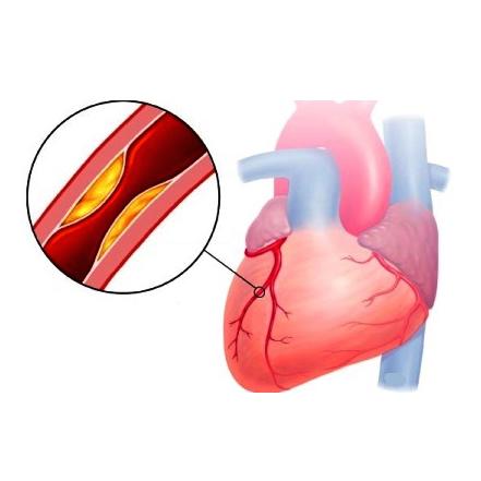 Thiếu máu cơ tim nên ăn gì để bệnh nhanh thuyên giảm? - 2