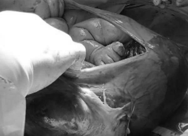 Ảnh hiếm hoi về các ca amp;#34;đẻ bọc điềuamp;#34;, được cho là em bé có số may mắn cả đời - 8