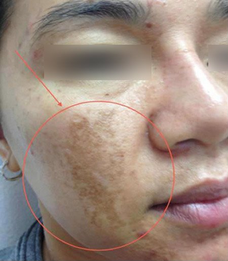 Bộ sản phẩm Nám, Tàn nhang Vương Phi - giải pháp hoàn hảo lấy lại sắc xuân cho làn da - 1