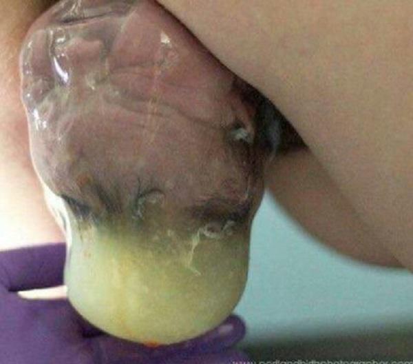 Ảnh hiếm hoi về các ca amp;#34;đẻ bọc điềuamp;#34;, được cho là em bé có số may mắn cả đời - 6