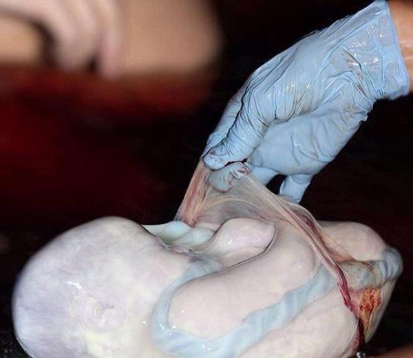 Ảnh hiếm hoi về các ca amp;#34;đẻ bọc điềuamp;#34;, được cho là em bé có số may mắn cả đời - 9