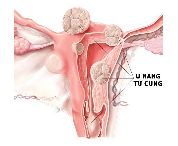 U nang tử cung là gì nguyên nhân dấu hiệu và cách điều trị ...