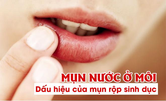 Mụn nước ở môi có phải dấu hiệu của bệnh mụn rộp sinh dục? - 1