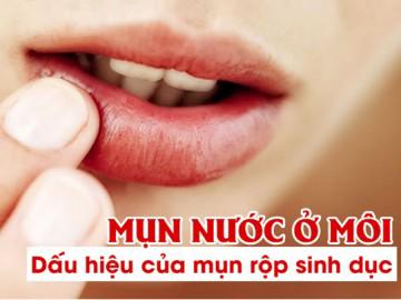 Mụn nước ở môi có phải dấu hiệu của bệnh mụn rộp sinh dục?