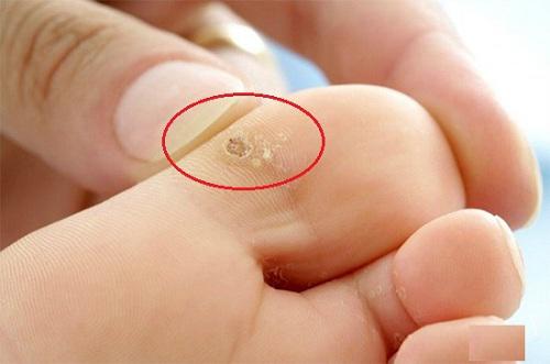 Truyền tay nhau cách trị mụn cóc này, hàng nghìn chị em đã chữa khỏi tận gốc! - 1